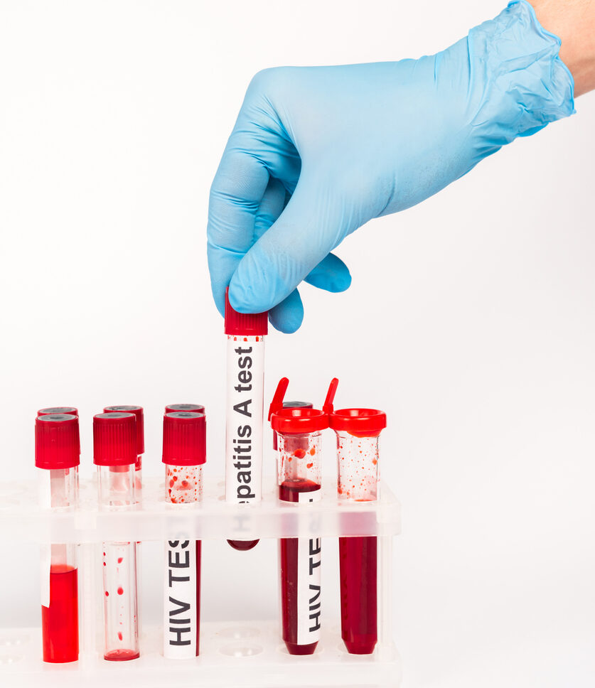 HIV and Hepatitis Blood Test